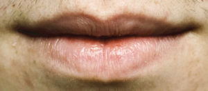 lip-cancer